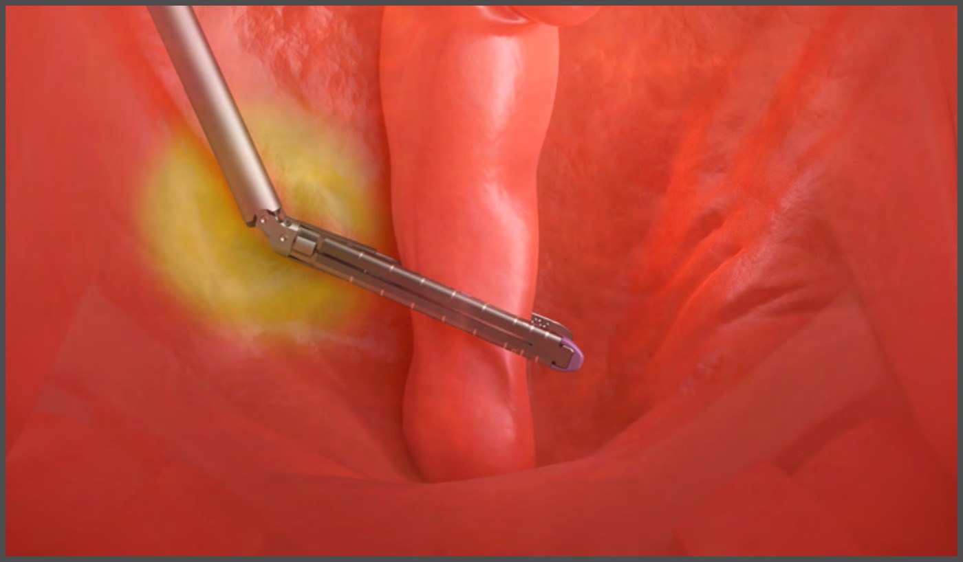 Endoscopic view: a conventional 45-degree reload approaching the rectum at an oblique angle, close to the tumour site.