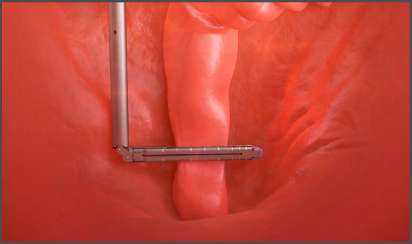 Endoscopic view: the Ultraflex 90 reload positioned square across the rectum, away from the tumour site.