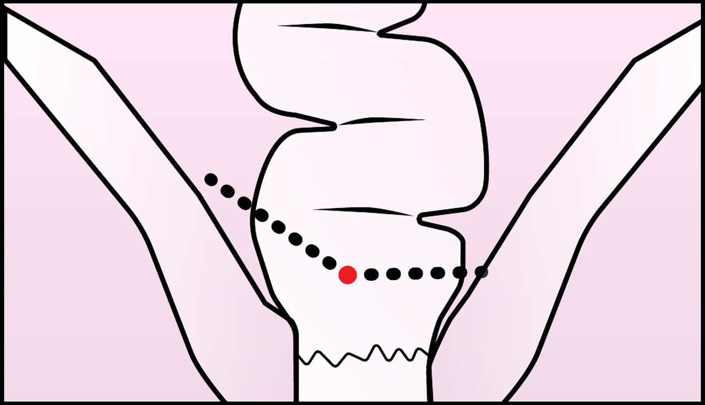 Diagram: two overlapping staple lines crossing at a point marked in red, the origin of leakage risk.
