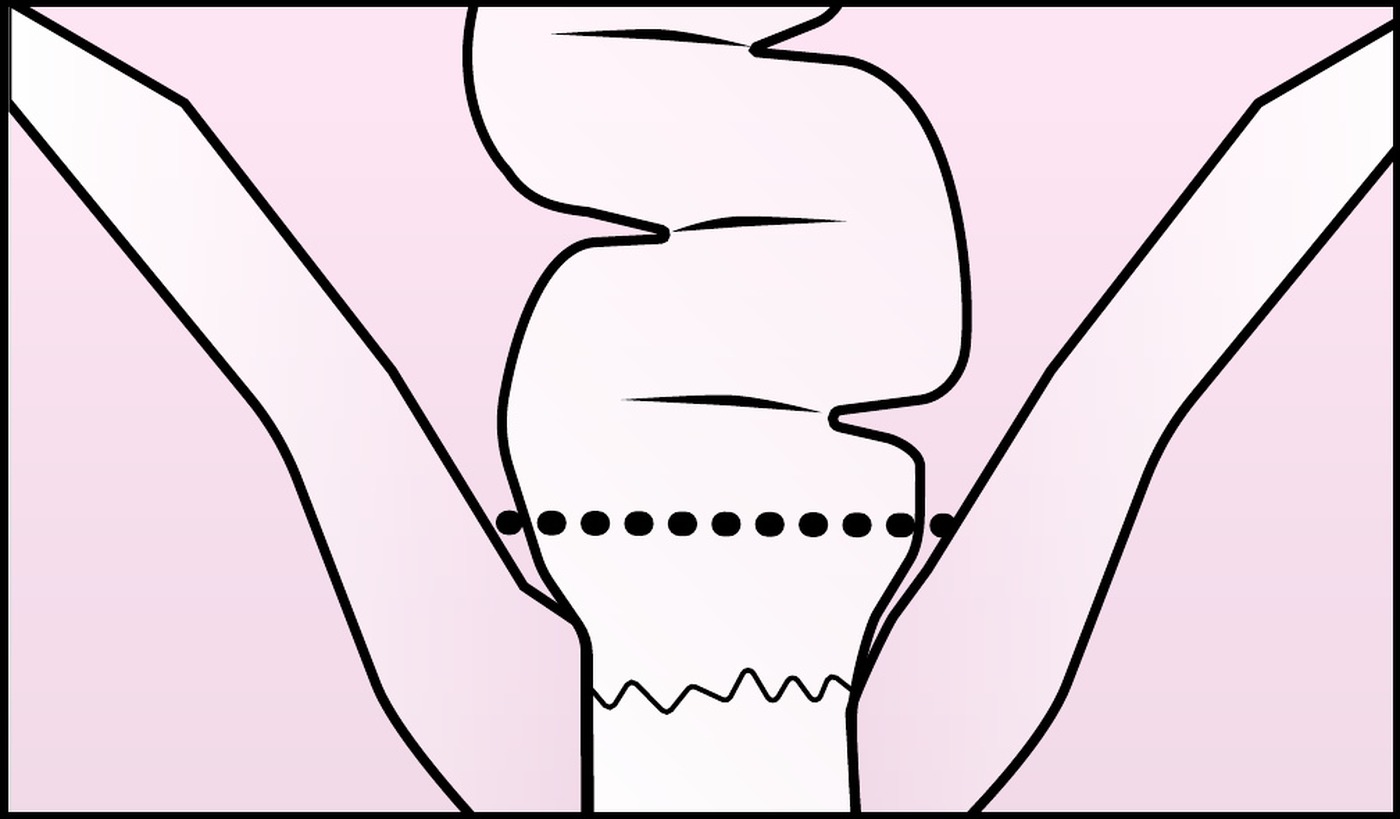 Diagram: a single continuous staple line across the rectum with no crossing point.