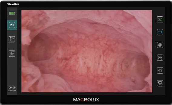The uterine cavity shown on the ViewHub S13 screen.